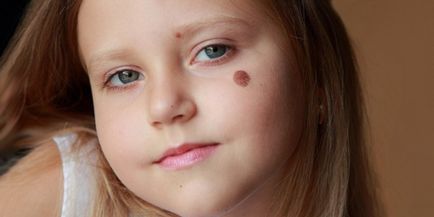 Din ce apar alunițe - cauzele feței și corpului la copii și adulți, video
