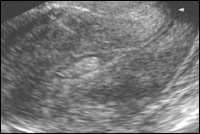 Patologia diagnosticare cu ultrasunete endometrial in practica ginecologice
