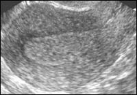 Patologia diagnosticare cu ultrasunete endometrial in practica ginecologice