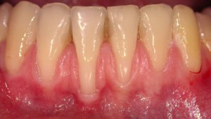 De ce dintii mancarime si gingiile sunt un adult sau un adolescent
