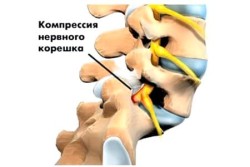 Lombara degenerative cauzele bolii de disc, simptome, tratament