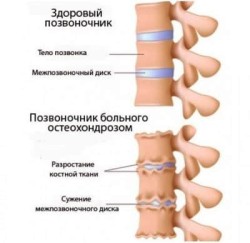 Lombara degenerative cauzele bolii de disc, simptome, tratament