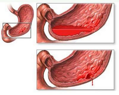 Simptome perforate ulcer gastric și la stadiul de dezvoltare