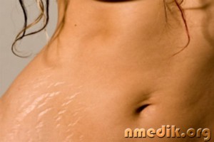 vergeturi pe piele - cauze, tratamentul și prevenirea