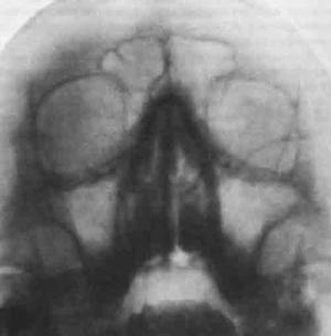 Radiografia sinusurilor paranazale indicatiile pentru decodificarea cu raze X PPN