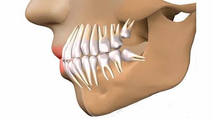 dinte și distopic impactate și dacă este necesară îndepărtarea