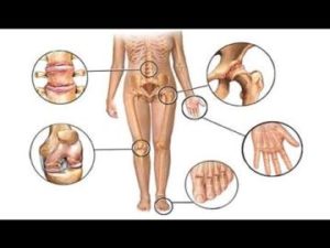 Reteta pentru tratamentul osteoartritei genunchiului