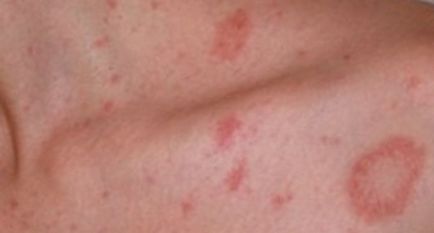 Pink zosterian Gibert cauze, simptome, infecțioase sau nu