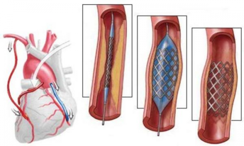 Heart nave chirurgie de by-pass ce este, cât de mulți trăiesc