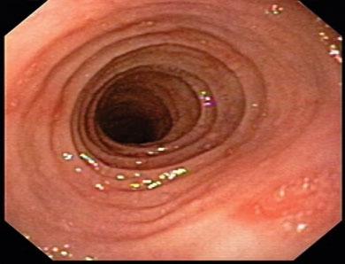 Simptomele si tratamentul esofagului esofagita, prognostic și diagnostic, dieta in boala