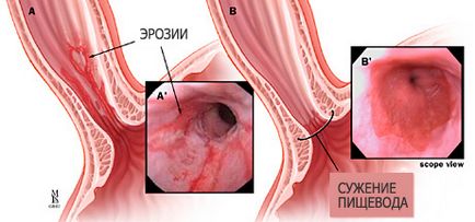 Simptomele si tratamentul esofagului esofagita, prognostic și diagnostic, dieta in boala