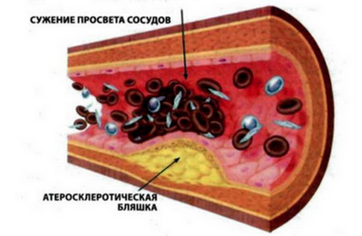 Scleroză de aorta, care este, cauzele, simptomele, tratamentul