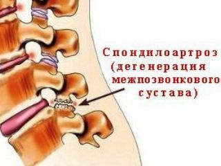 Spondylarthrosis lombare și tratamentul simptomelor