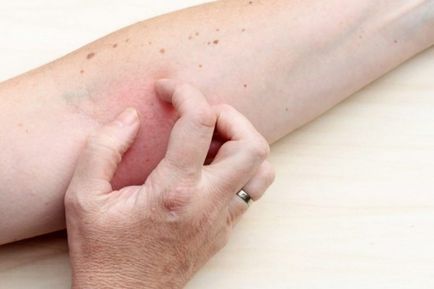 eczeme tratament uscat, modul de a trata decât pentru a vindeca de pe palme
