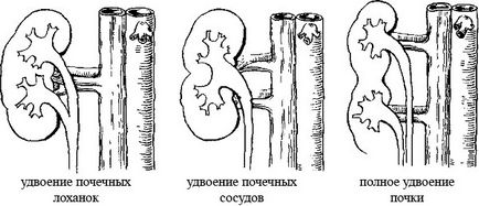 Dublarea rinichilor cauze, complicații, tratamentul