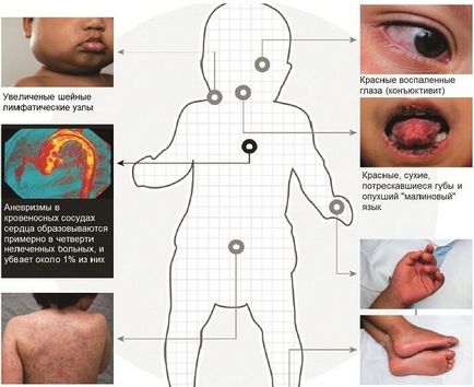 Vasculita - diagnostic, simptome, clasificarea și tratamentul bolii