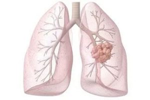 Indepartarea chirurgicala a cancerului pulmonar și reabilitarea ulterior