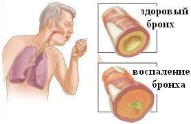Simptomele cronice bronșitei și tratament la adulți