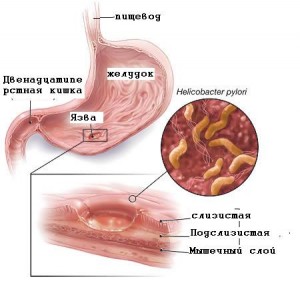ulcerul gastric si ulcerul duodenal simptome, tratament, cauze,