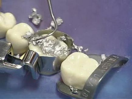 plombe dentare în stomatologie - argumente pro și contra, modul de a alege un sigiliu