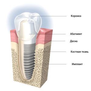 proteze dentare din noua generație de stomatologie moderne