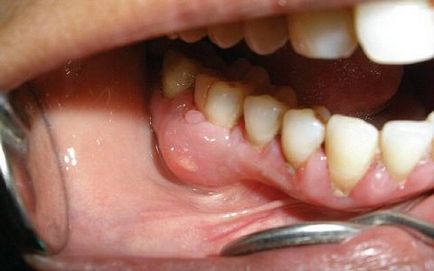 Ce este un abces al gingiilor