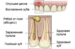 Ce este un abces al gingiilor