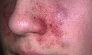 eczeme tratament facial