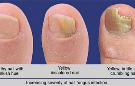 Ce se poate vindeca ciuperca unghiilor