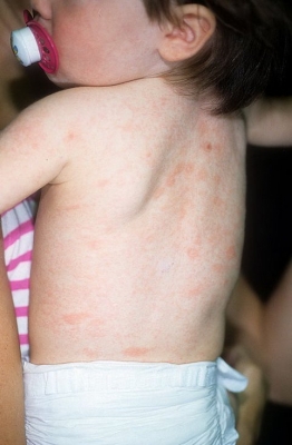Cum de a vindeca herpesul la copii