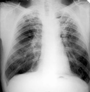 Ce este tuberculoma pulmonar