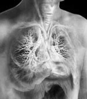 Ce este tuberculoma pulmonar