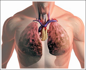 Ce este tuberculoma pulmonar