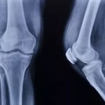 Tratamentul artrozei deformans remedii populare
