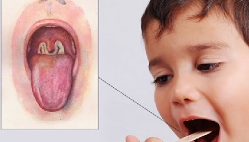 Difteria este că copilul