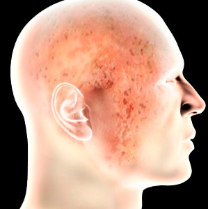 Eczema pe fata si capul cu cauzele si tratamentul