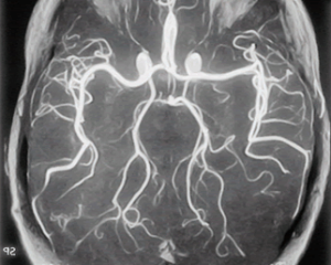 Tratamentul encefalopatiei cerebral