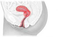 eroziune de col uterin