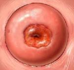 De col uterin Eroziune - cauze, simptome și tratament