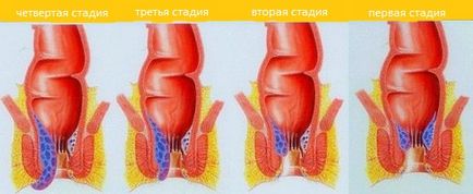 Cum de a trata hemoroizi la barbati