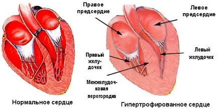 Tratamentul de hipertrofie a ventriculului stâng al inimii