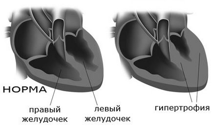 Tratamentul de hipertrofie a ventriculului stâng al inimii