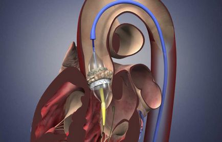 Tratamentul de hipertrofie a ventriculului stâng al inimii