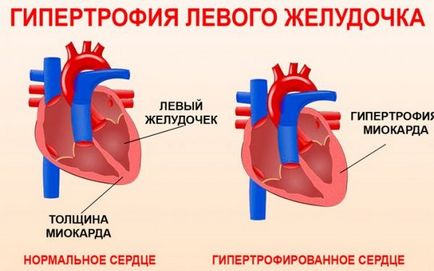 Hipertrofia ventriculului stâng simptomele și tratamentul