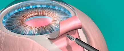 Glaucomul - Eye Surgery Center