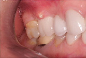 Un abces in guma - parodontale abces fotografie abces și tratarea dinților
