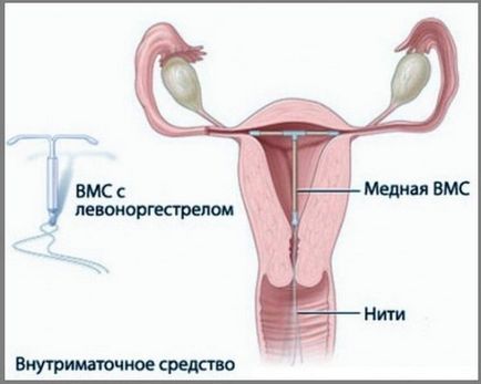 Intrauterine spirală Hormonale