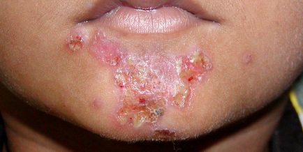 Impetigo este ceea ce este