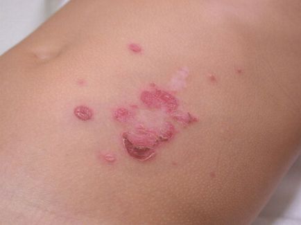 Impetigo este ceea ce este