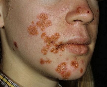 Impetigo este ceea ce este